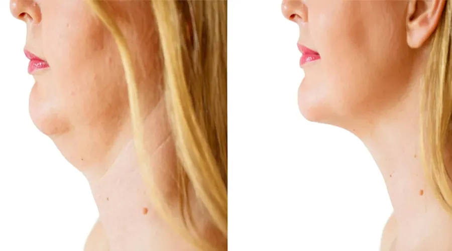 روغن رفع غبغب • آبان ۲۵ام, ۱۴۰۴ کاهش افتادگی چانه با روغن