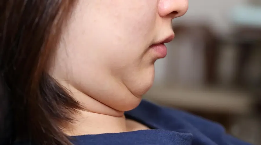 روغن رفع غبغب • آبان ۲۵ام, ۱۴۰۴ لیفت طبیعی چانه با روغن