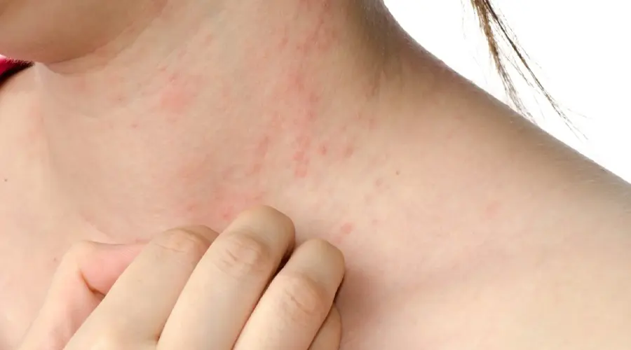 پماد ضد اگزما • دی ۲۶ام, ۱۴۰۴ پماد گیاهی اگزما بدون مواد شیمیایی