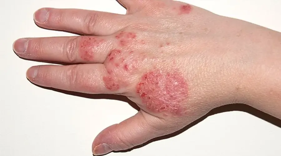 پماد ضد اگزما • دی ۲۶ام, ۱۴۰۴ پماد اگزما برای تسکین خارش و خشکی