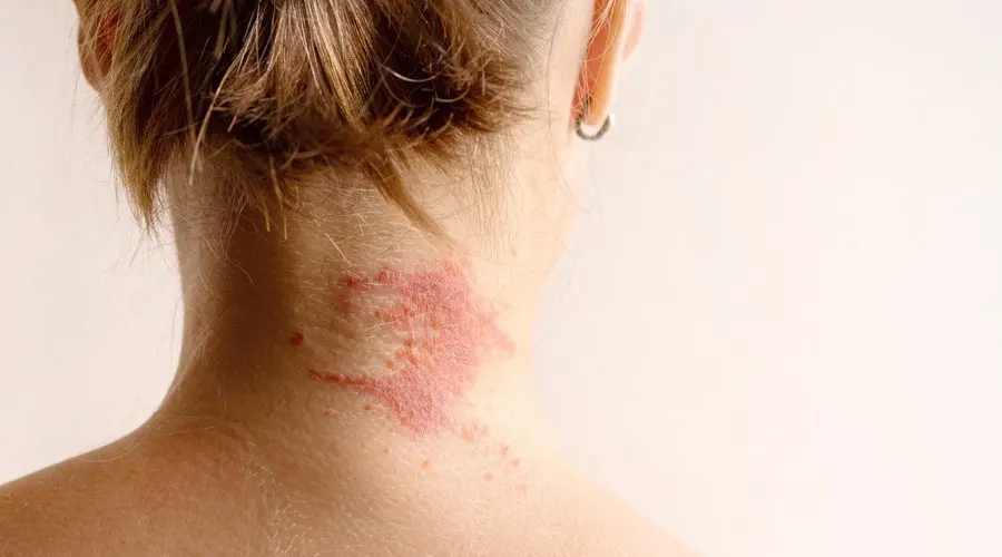 پماد ضد اگزما • دی ۲۶ام, ۱۴۰۴ خرید پماد ضد اگزما با ترکیبات طبیعی