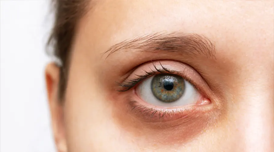 بهبود گردش خون زیر چشم با روغن