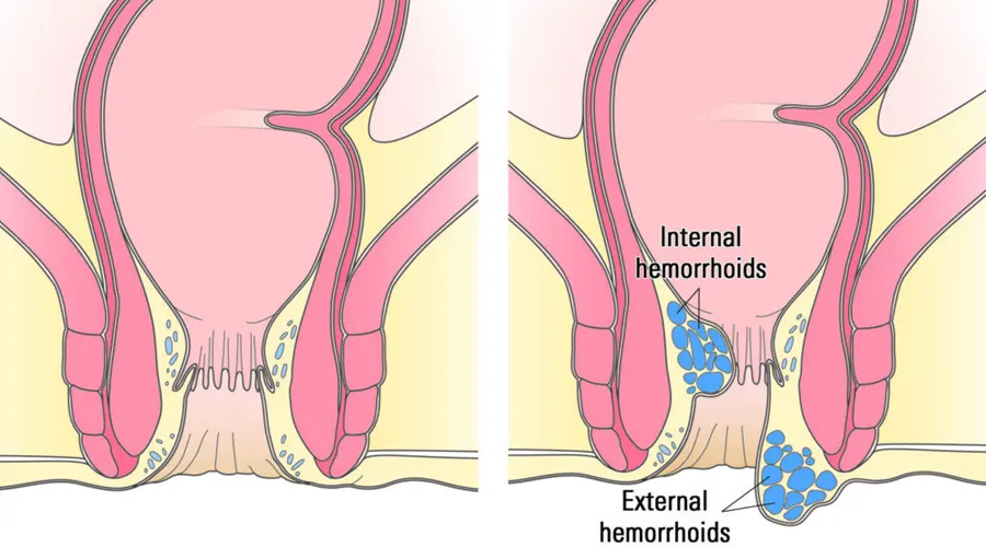 پماد بواسیر برای کاهش سوزش مقعد