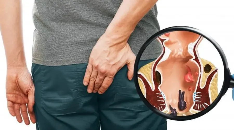 پماد بواسیر برای کاهش خارش و التهاب