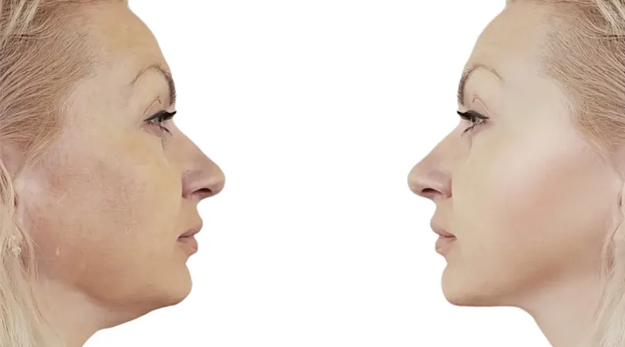 روغن رفع غبغب • آبان ۲۵ام, ۱۴۰۴ استفاده از روغن برای کاهش غبغب