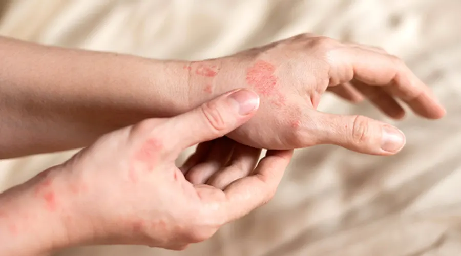 پماد ضد اگزما • دی ۲۶ام, ۱۴۰۴ پماد اگزما مناسب پوست خشک و حساس