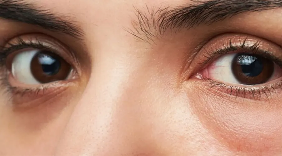 استفاده از قطره روغن دور چشم