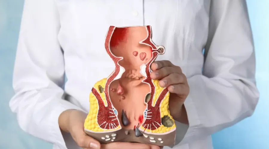 تسکین علائم بواسیر با پماد موضعی