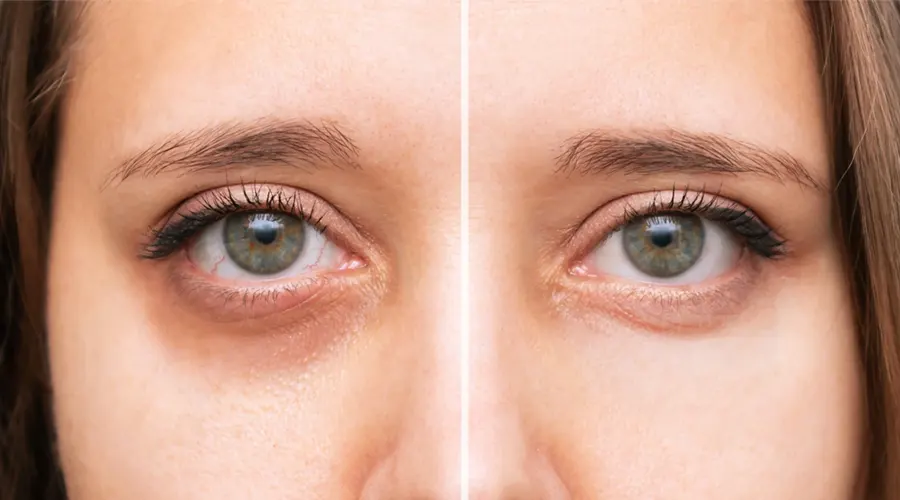 روغن دور چشم برای کاهش چین و چروک