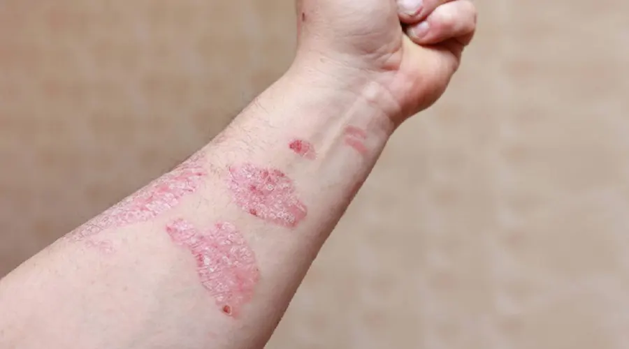 روغن کرچک برای پسوریازیس؛ راهکاری طبیعی برای تسکین پوست • آذر ۱۰ام, ۱۴۰۴ درمان پوستهپوسته شدن پوست با روغن کرچک