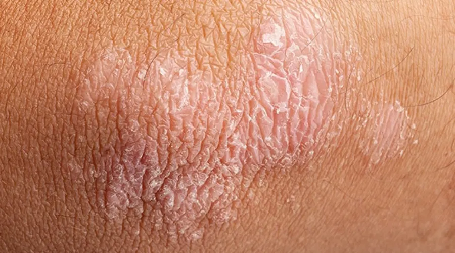 روغن کرچک برای پسوریازیس؛ راهکاری طبیعی برای تسکین پوست • آذر ۱۰ام, ۱۴۰۴ درمان طبیعی پسوریازیس با روغن کرچک