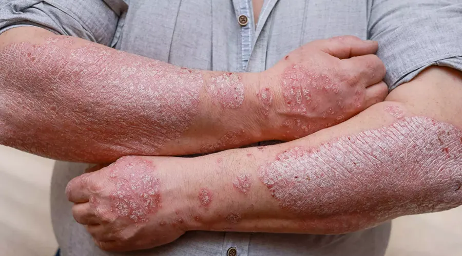 روغن کرچک برای پسوریازیس؛ راهکاری طبیعی برای تسکین پوست • آذر ۱۰ام, ۱۴۰۴ روغن کرچک و بهبود علائم پسوریازیس مزمن