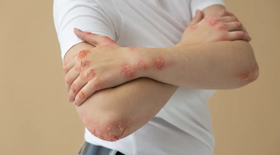 روغن کرچک برای پسوریازیس؛ راهکاری طبیعی برای تسکین پوست • آذر ۱۰ام, ۱۴۰۴ بهبود تدریجی علائم پسوریازیس با روغن کرچک