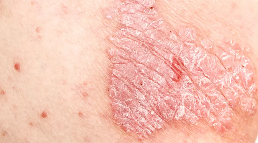 روغن کرچک برای پسوریازیس؛ راهکاری طبیعی برای تسکین پوست • آذر ۱۰ام, ۱۴۰۴ اثر ضدالتهابی روغن کرچک روی پوست ملتهب