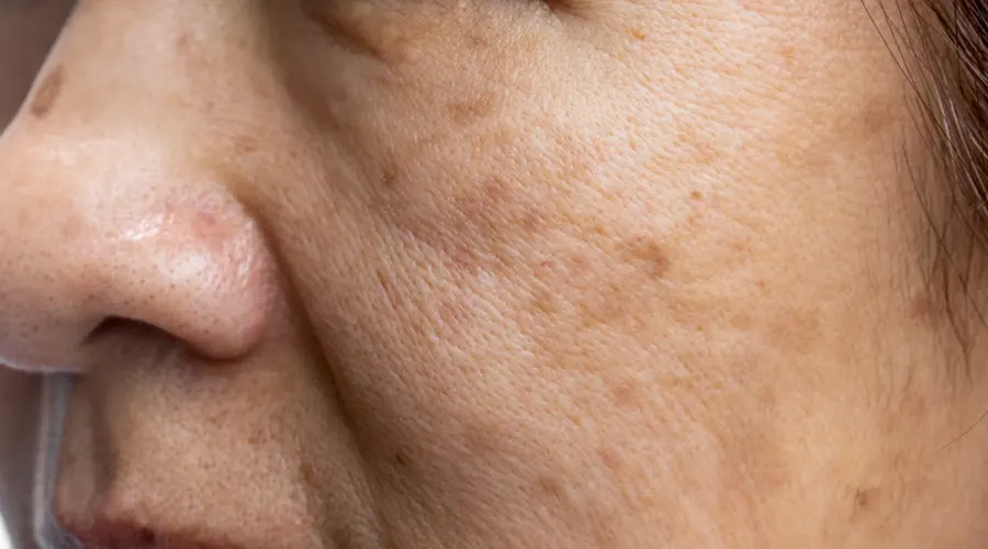 درمان طبیعی لک صورت بدون لیزر