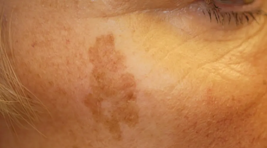 درمان لک‌های پوستی بدون مواد شیمیایی