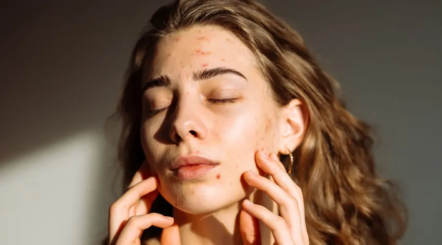 روغن جوجوبا برای درمان جوش