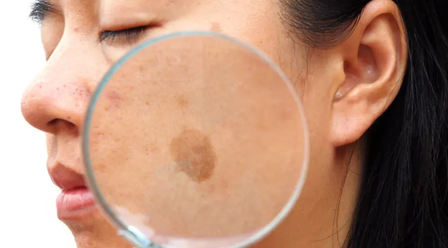 درمان لک‌های تیره صورت با روغن سیاه دانه