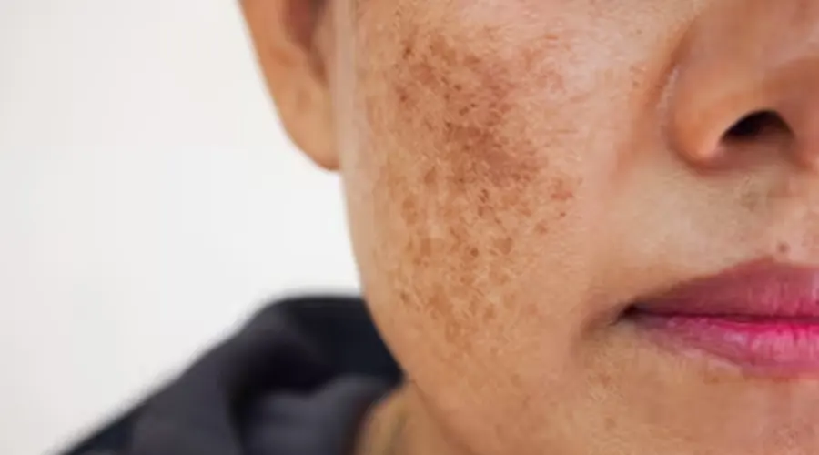 استفاده از روغن سیاه دانه آلسی هرب برای لک پوست