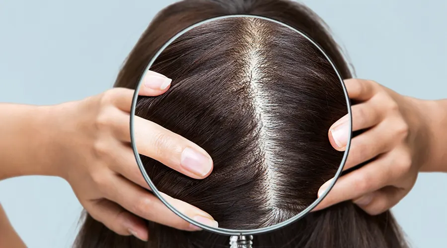 ماساژ روغن رزماری روی کف سر برای کنترل چربی